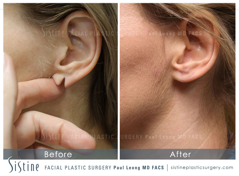 Earlobe Repair Before and After | Sistine Facial Plastic Surgery