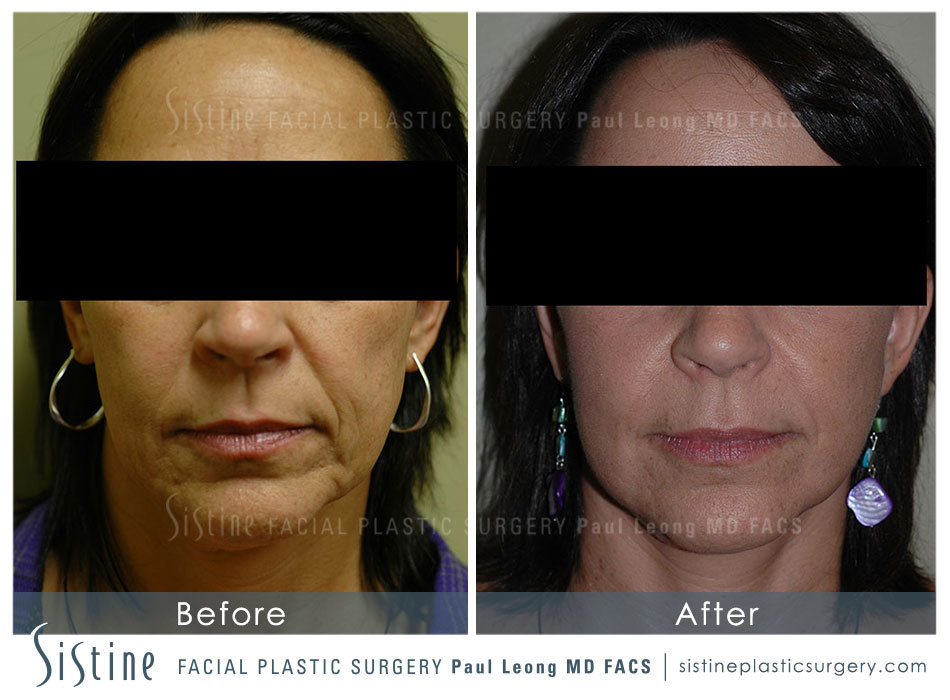 Fat Transfer Injections Before and After | Sistine Facial Plastic Surgery