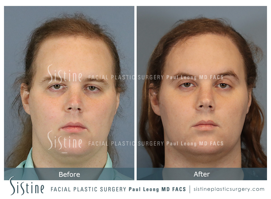 Hair Transplant Before and After | Sistine Facial Plastic Surgery