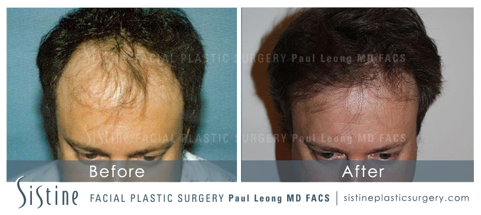 Hair Transplant Before and After | Sistine Facial Plastic Surgery