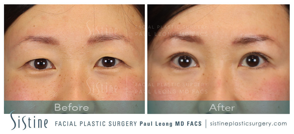 Asian Blepharoplasty Before and After | Sistine Facial Plastic Surgery
