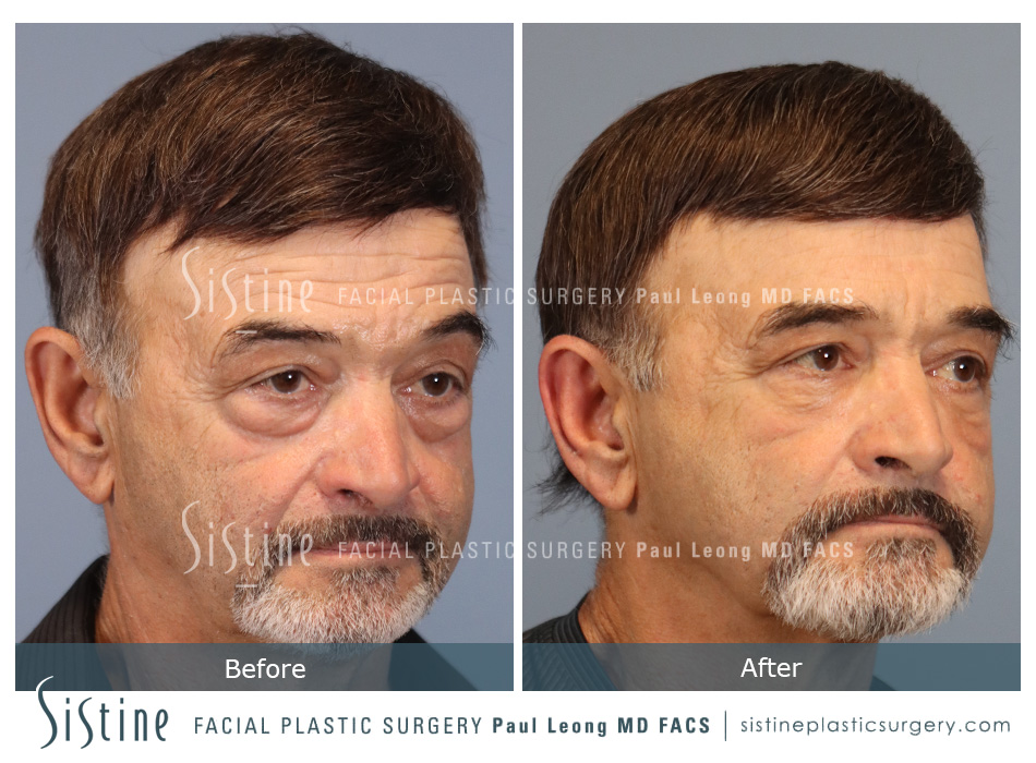 Face and Neck Lift Pittsburgh PA - Left Oblique Preoperative View | Sistine Facial Plastic Surgery