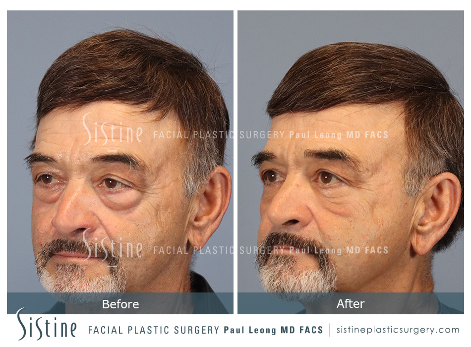 Sewickley Face and Neck Lift | Left Later Preoperative View | Sistine Facial Plastic Surgery