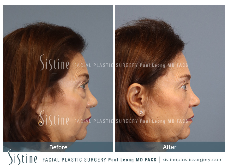 Blepharoplasty - Preoperative View | Sistine Facial Plastic Surgery