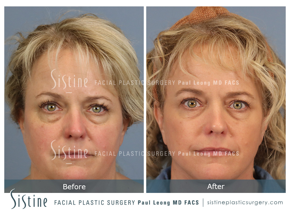 Blepharoplasty (Before/After) - Sistine Facial Plastic Surgery