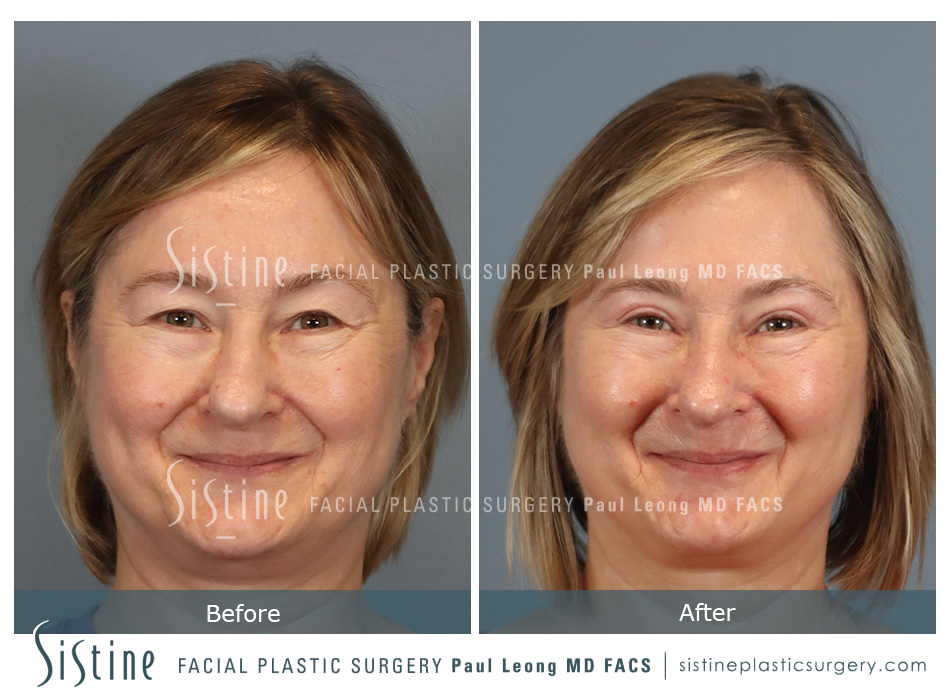 Pittsburgh PA Blepharoplasty - Left Oblique Preoperative View | Dr. Paul Leong