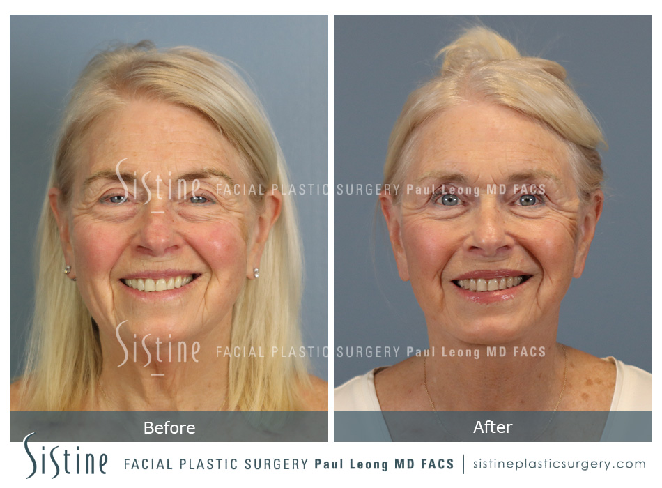 Transconjuctival Blepharoplasty - Preoperative View | Sistine Facial Plastic Surgery
