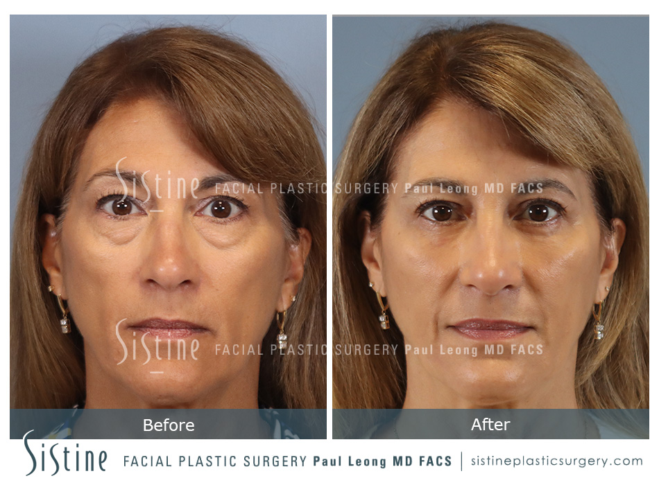 Eyelid Lift Pittsburgh PA - Preoperative View | Sistine Facial Plastic Surgery