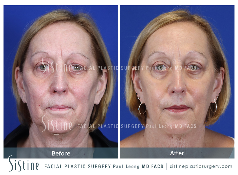 Blepharoplasty - Preoperative View | Sistine Facial Plastic Surgery