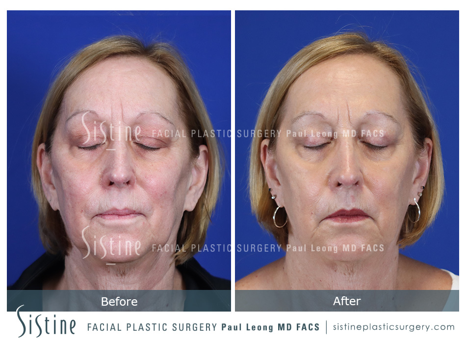 Pittsburgh High SMAS Facelift - Preoperative Left Oblique View | Sistine Facial Plastic Surgery
