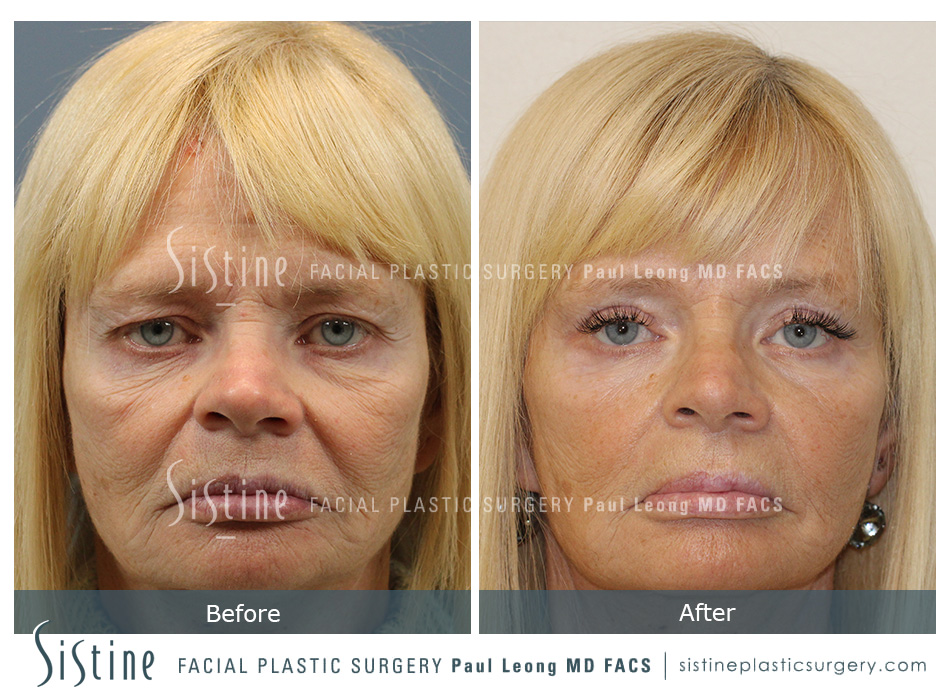 Pittsburgh Blepharoplasty - Preoperative Frontal View | Dr. Paul Leong
