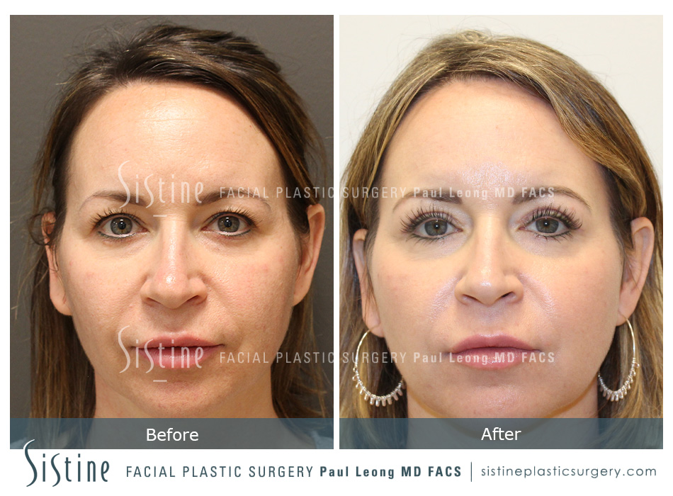 Blepharoplasty Surgery - Preoperative View | Dr. Paul Leong