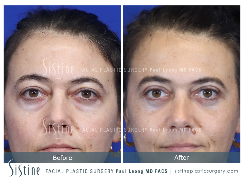 Upper Eyelid Blepharoplasty - Before Surgery | Sistine Facial Plastic Surgery