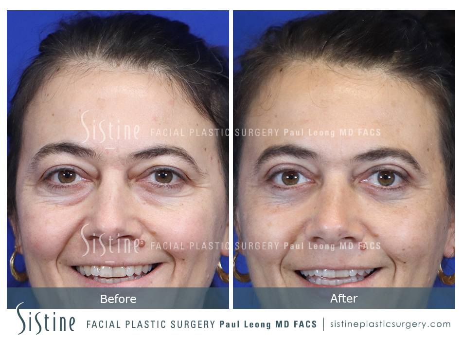 Pittsburgh PA Eyelid Lift - Preoperative View | Sistine Facial Plastic Surgery