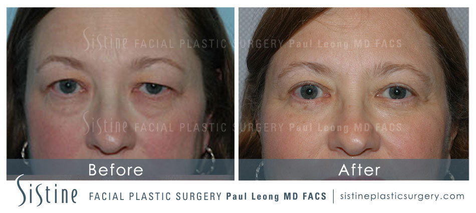 Pittsburgh PA Eyelid Surgery Photos - Preoperative View | Sistine Facial Plastic Surgery