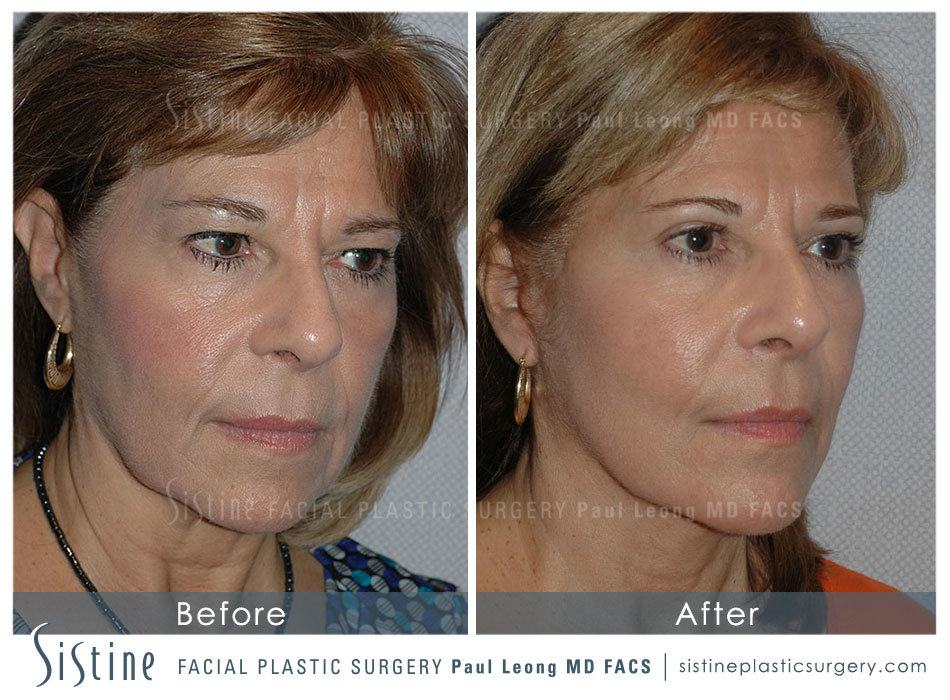  Facelift for Men Pittsburgh - Before Surgery | Sistine Facial Plastic Surgery