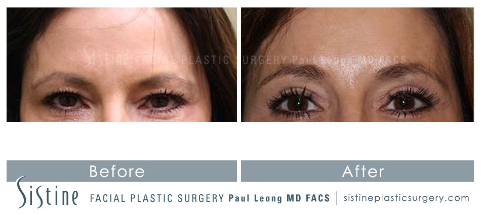 Sub SMAS Facelift Pittsburgh - Preoperative Frontal View | Dr. Paul Leong