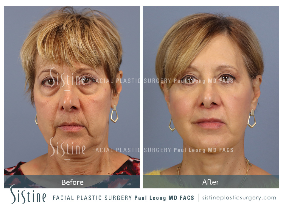 Blepharoplasty Before and After | Sistine Facial Plastic Surgery