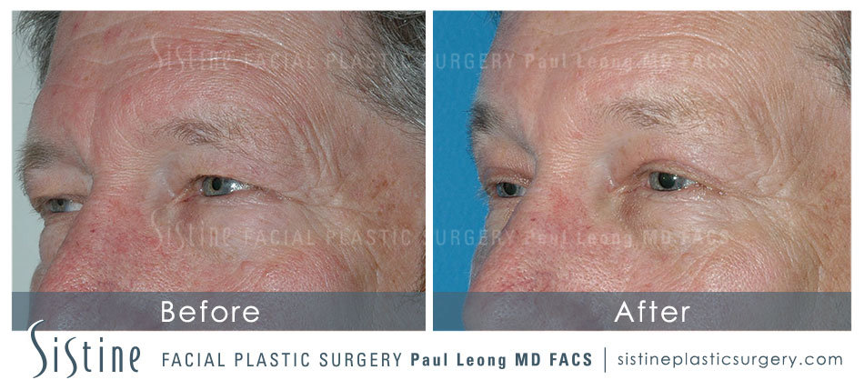Browlift in Pittsburgh PA - Before Image | Dr. Paul Leong