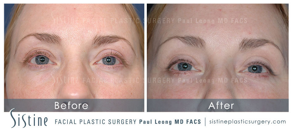 Pittsburgh PA Endoscopic Brow Lift - Before Surgery | Sistine Facial Plastic Surgery  