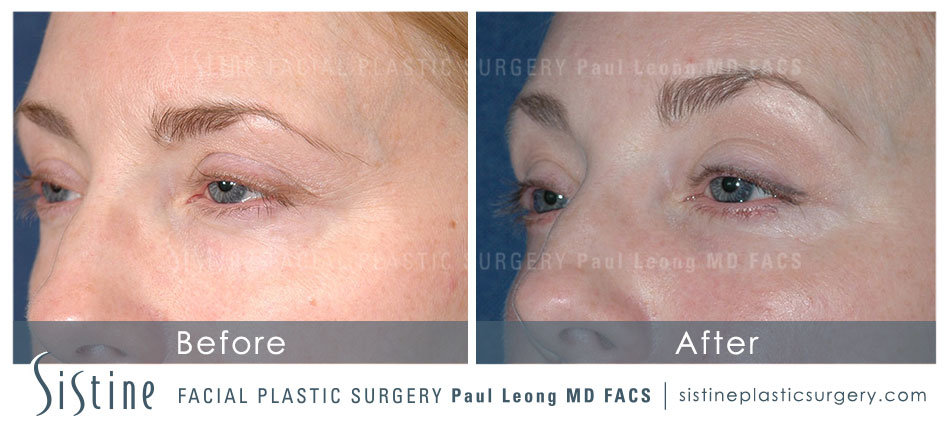 Endoscopic Brow Lift Pittsburgh PA - Preoperative Right Oblique View | Sistine Facial Plastic Surgery