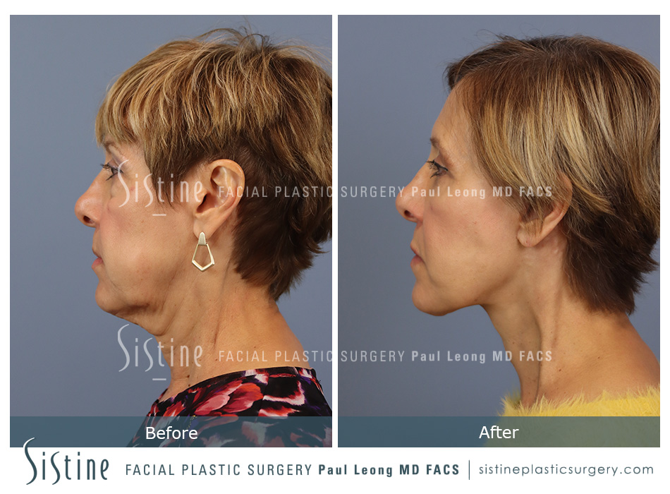 Browlift Before and After | Sistine Facial Plastic Surgery