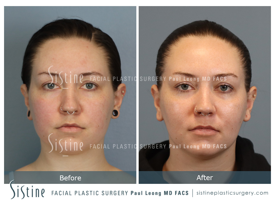 High SMAS Facelift in Pittsburgh - Preoperative Frontal View | Sistine Facial Plastic Surgery