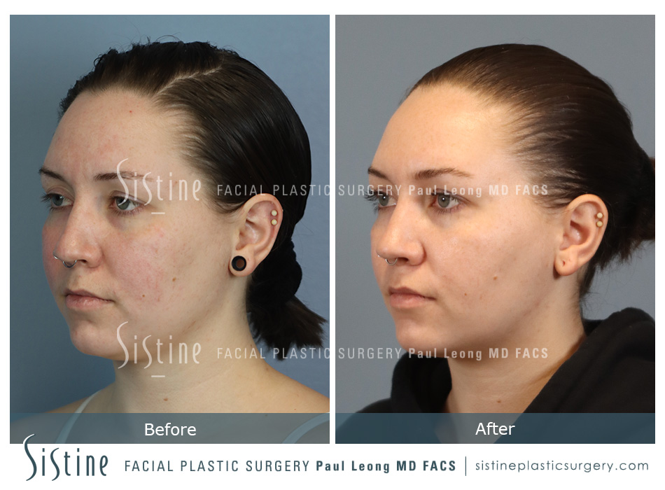 Pittsburgh High SMAS Facelift - Preoperative Right Lateral View | Sistine Facial Plastic Surgery