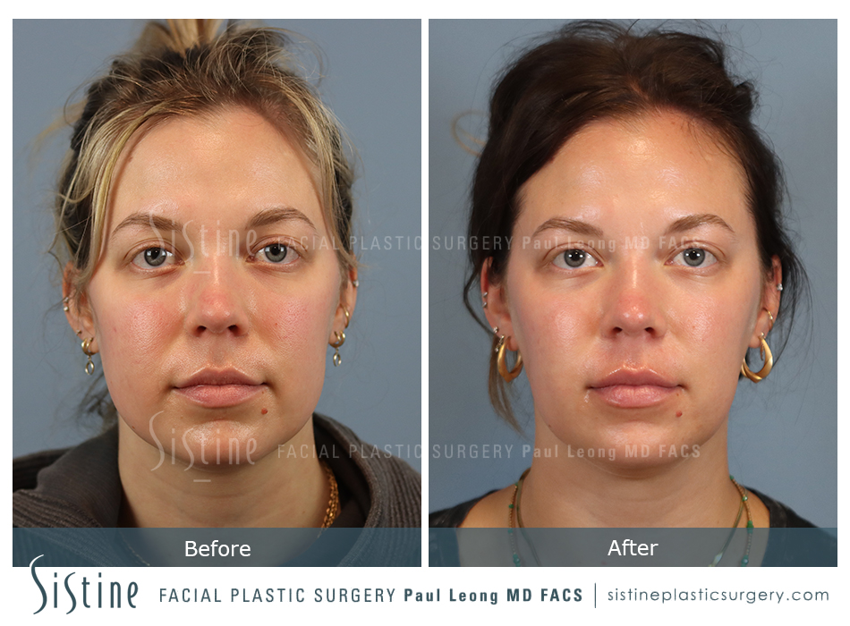 Chin Augmentation - Patient Preoperative View | Sistine Facial Plastic Surgery