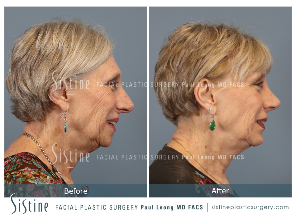Chin Implant Before and After | Sistine Facial Plastic Surgery
