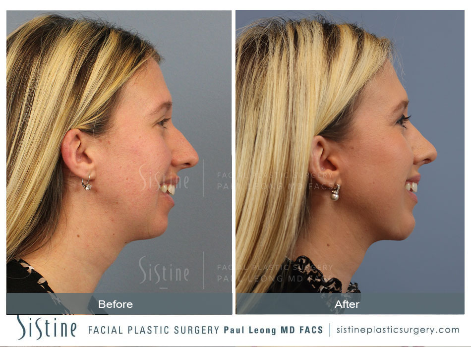 Chin Implant Before and After | Sistine Facial Plastic Surgery