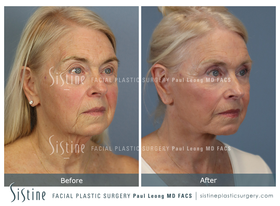 Pittsburgh High SMAS Facelift - Preoperative Right Oblique View | Sistine Facial Plastic Surgery