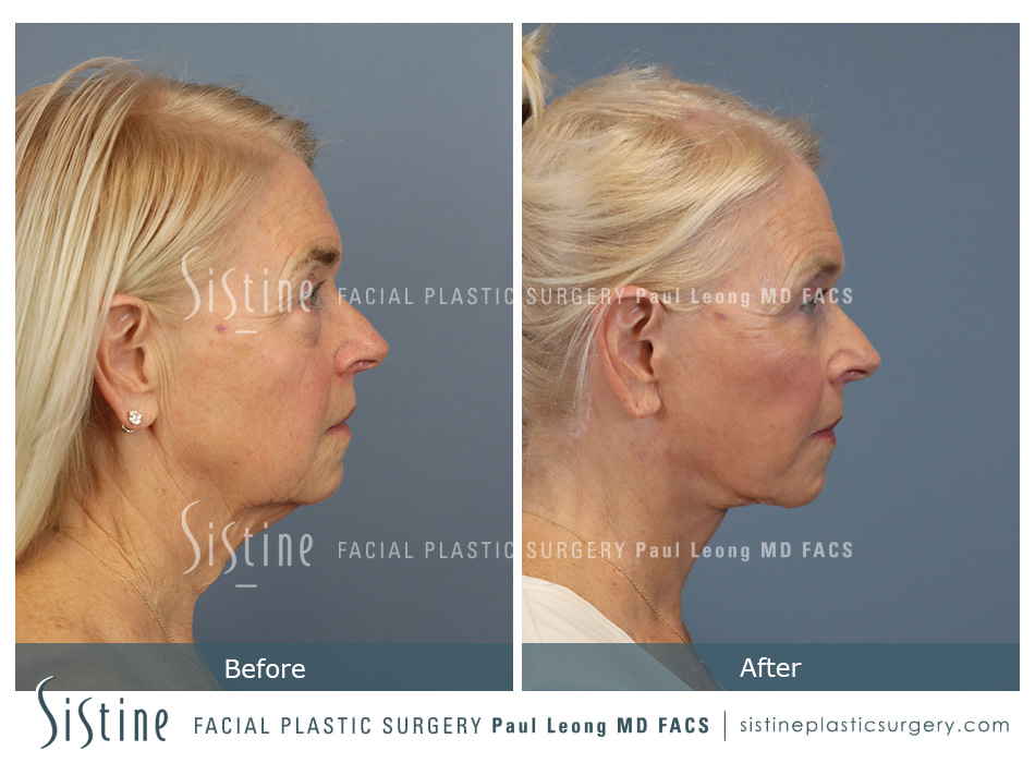 Pittsburgh High SMAS Facelift - Preoperative Right Lateral View | Sistine Facial Plastic Surgery