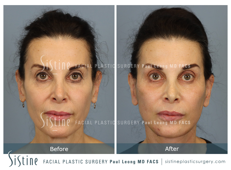 Pittsburgh High SMAS Facelift - Preoperative Right Oblique View | Sistine Facial Plastic Surgery