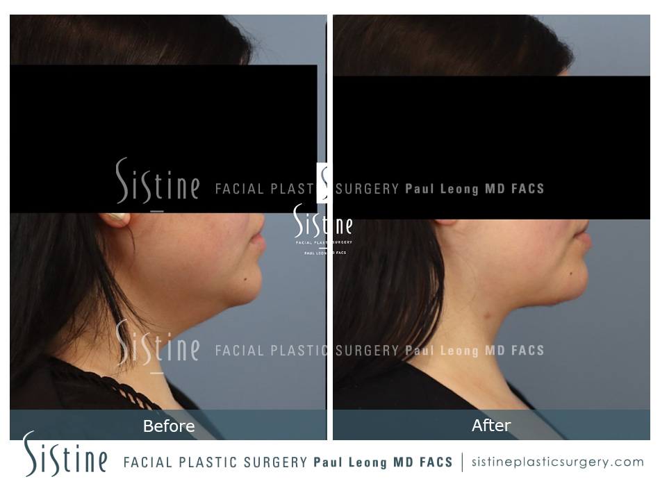 Deep Neck Lift Before and After | Sistine Facial Plastic Surgery