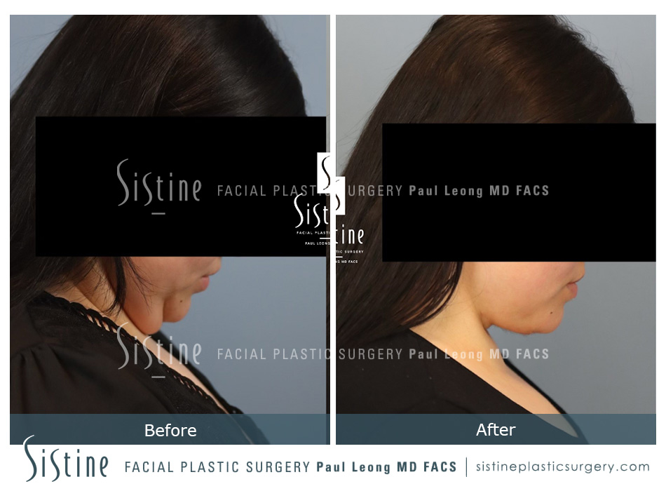 Pittsburgh Face and Neck Lift - Preoperative Left Oblique View | Dr. Paul Leong