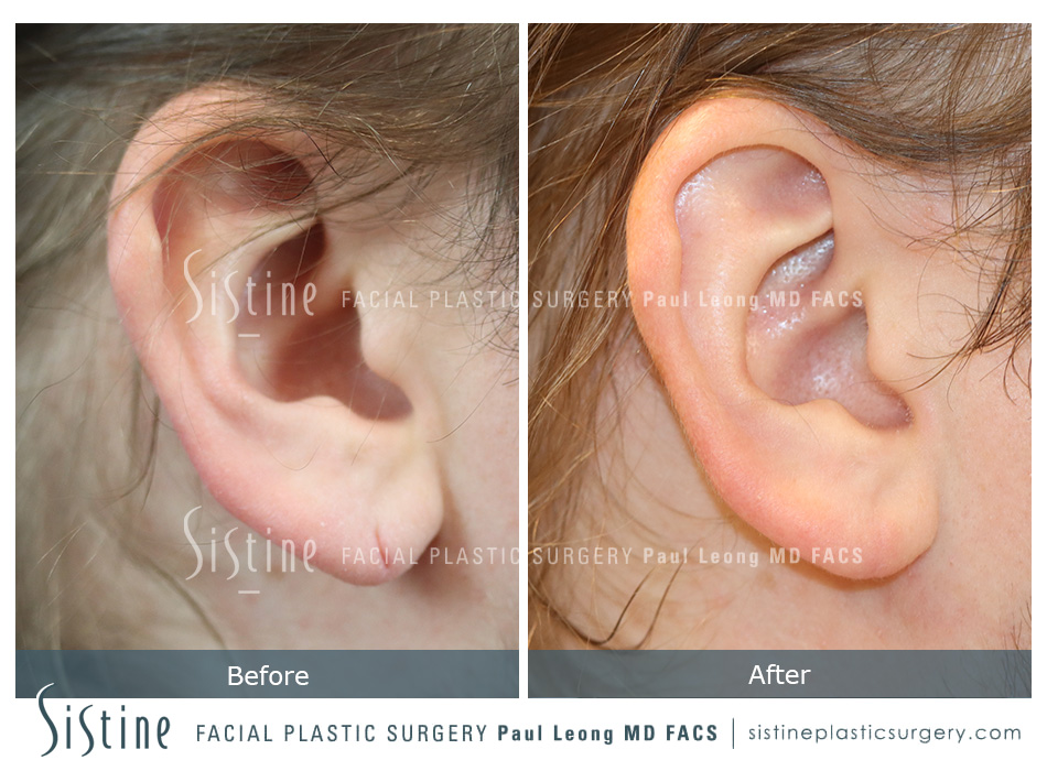 Earlobe Repair Pittsburgh - Preoperative appearance of earlobe in natural position