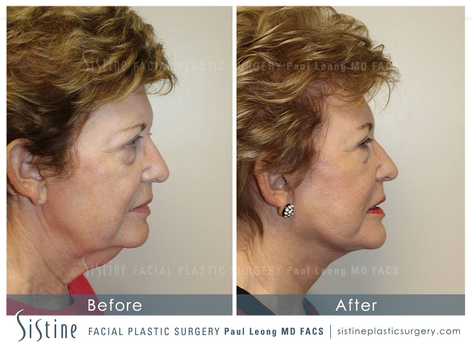 Face Lift Pittsburgh - Before Surgery | Sistine Facial Plastic Surgery