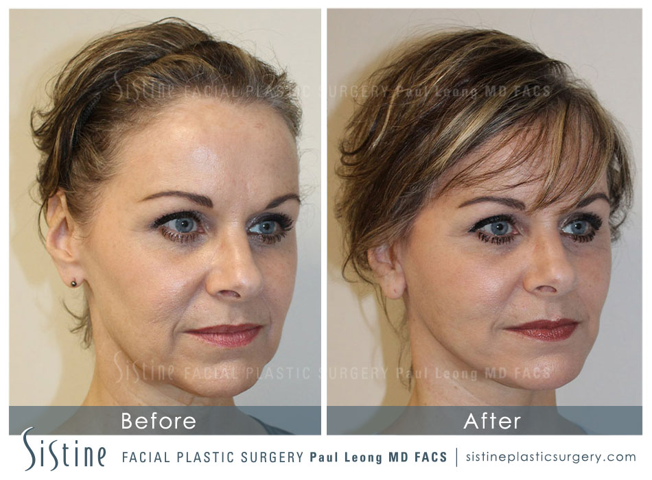 Facelift Before and After | Sistine Facial Plastic Surgery