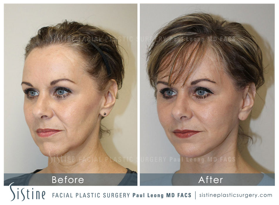 Facelift Before and After 13 Sistine Facial Plastic Surgery