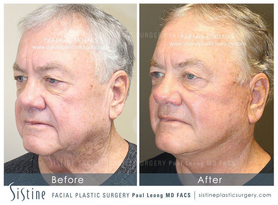 Facelift Before and After 14 Sistine Facial Plastic Surgery
