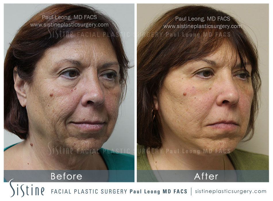 Facelift Before and After 15 Sistine Facial Plastic Surgery