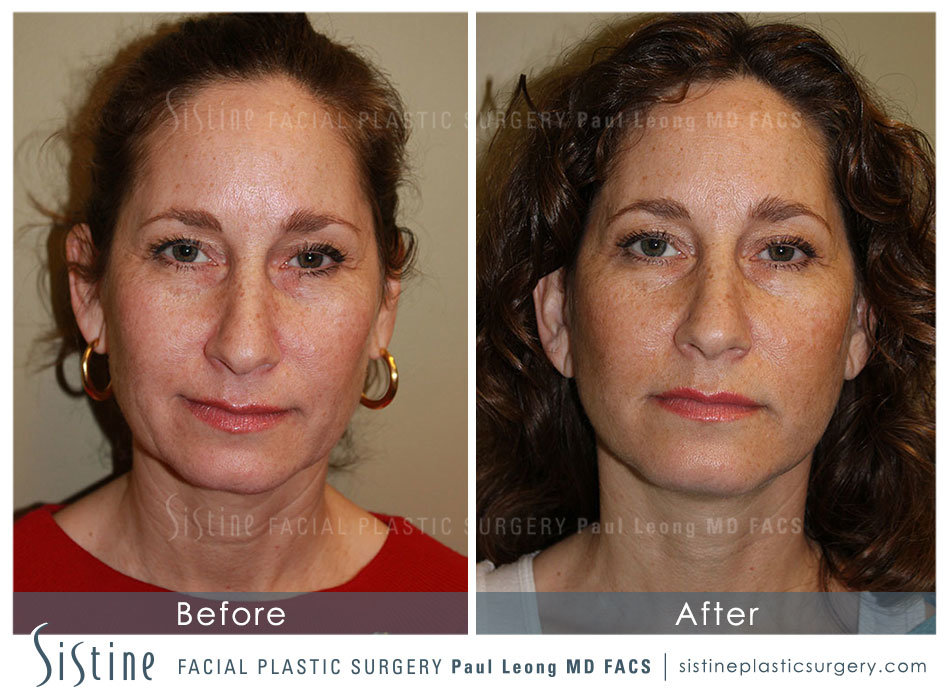 Facelift Before and After | Sistine Facial Plastic Surgery