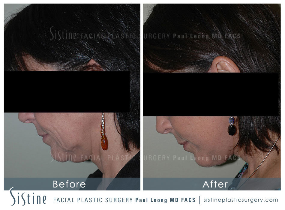 Fat Transfer Injections Before and After | Sistine Facial Plastic Surgery