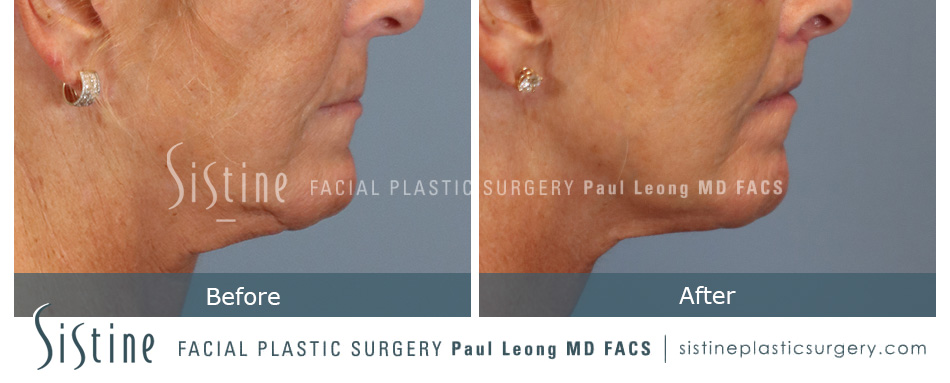 Lip Lift Before and After | Sistine Facial Plastic Surgery