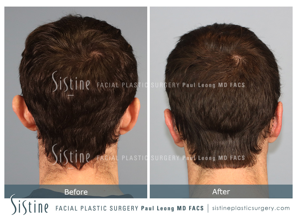 Otoplasty Before and After | Sistine Facial Plastic Surgery