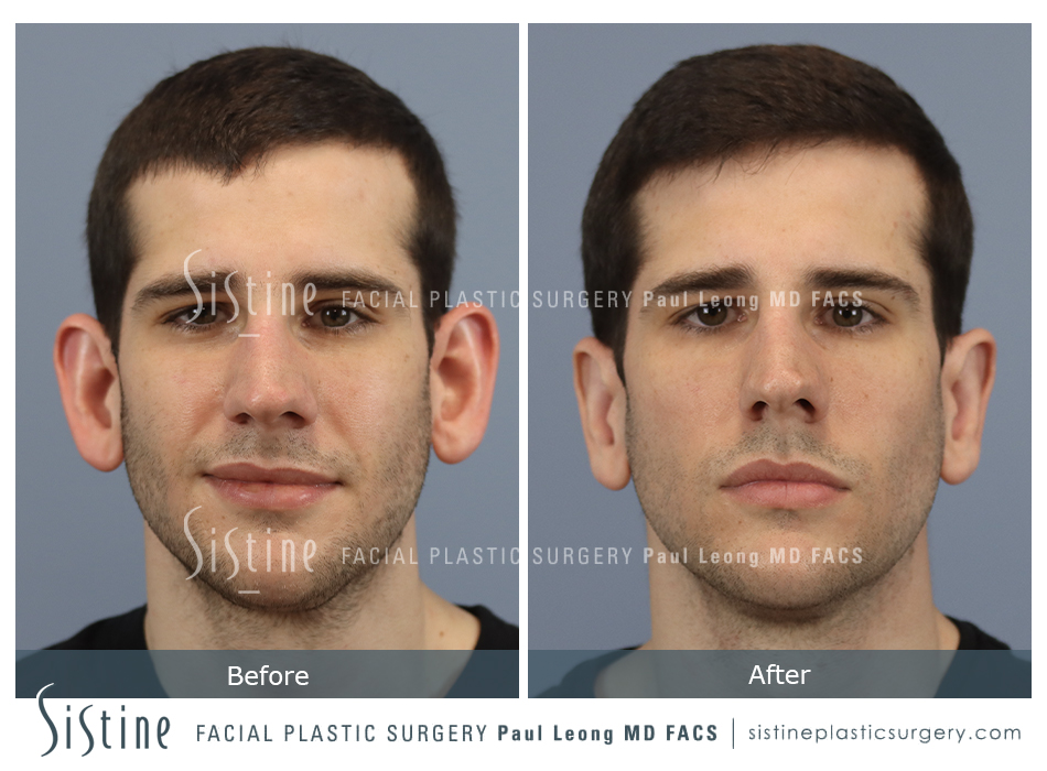 Otoplasty Surgery Pittsburgh PA - Frontal Preoperative View | Sistine Facial Plastic Surgery