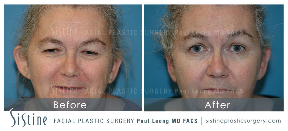 Otoplasty Surgery Pittsburgh PA - Frontal Preoperative View | Sistine Facial Plastic Surgery