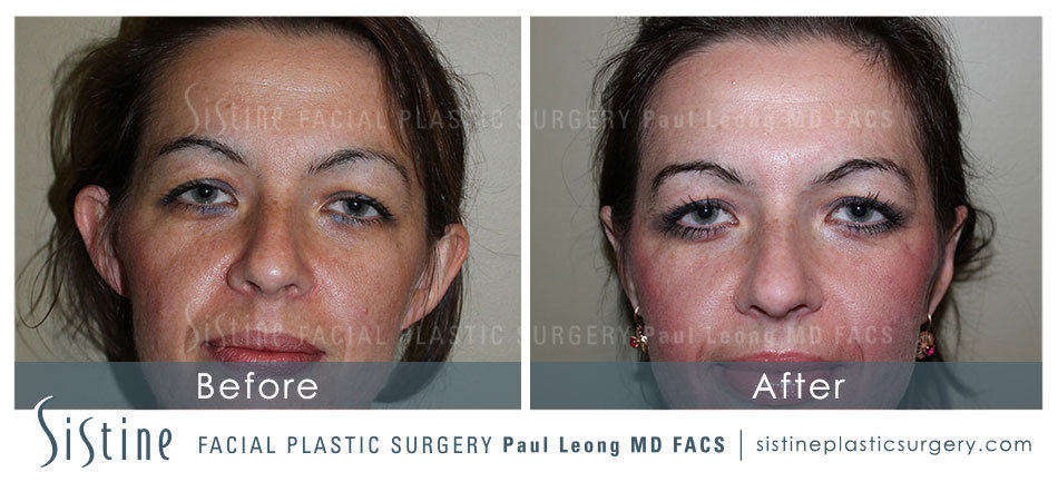 Otoplasty Before and After | Sistine Facial Plastic Surgery