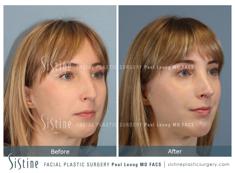 Will Rhinoplasty Help My Breathing - Patient Preopeartive View | Dr. Paul Leong, Pittsburgh PA